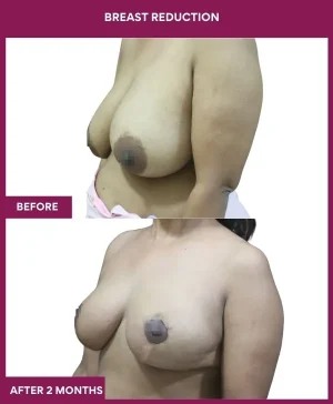 breast-reduction-surgery-before-after-results-mumbai-india-patient07-side-left