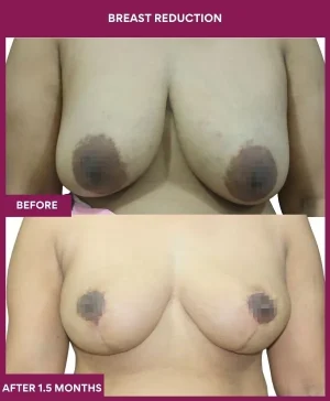 breast-reduction-surgery-before-after-results-mumbai-india-patient08-front