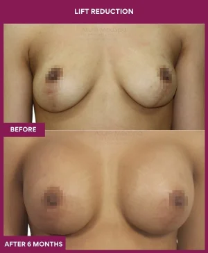 breast-reduction-with-lift-before-after-results-mumbai-india-patient01-front