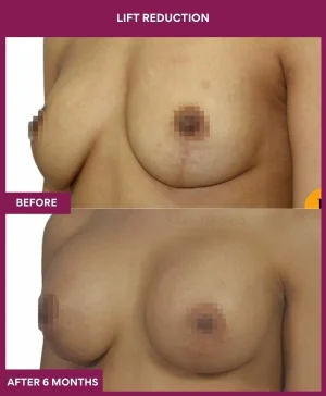 breast-reduction-with-lift-before-after-results-mumbai-india-patient01-side-left