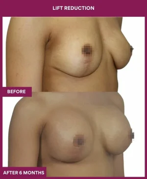 breast-reduction-with-lift-before-after-results-mumbai-india-patient01-side-right