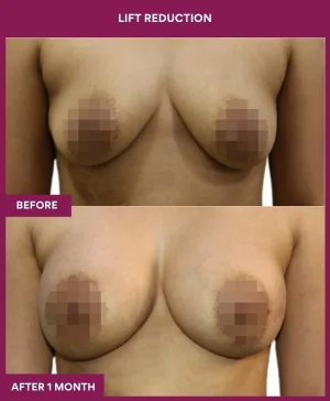 breast-reduction-with-lift-before-after-results-mumbai-india-patient02-front