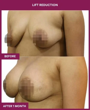 breast-reduction-with-lift-before-after-results-mumbai-india-patient02-side-left
