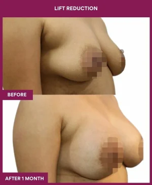 breast-reduction-with-lift-before-after-results-mumbai-india-patient02-side-right