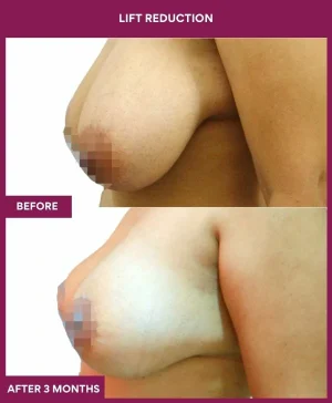 breast-reduction-with-lift-before-after-results-mumbai-india-patient03-side-left