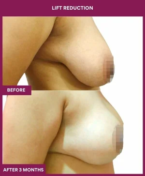 breast-reduction-with-lift-before-after-results-mumbai-india-patient03-side-right