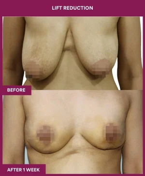 breast-reduction-with-lift-before-after-results-mumbai-india-patient04-front
