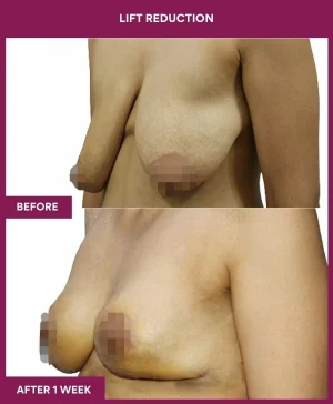 breast-reduction-with-lift-before-after-results-mumbai-india-patient04-side-left