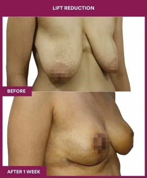 breast-reduction-with-lift-before-after-results-mumbai-india-patient04-side-right