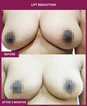 breast-reduction-with-lift-before-after-results-mumbai-india-patient05-front