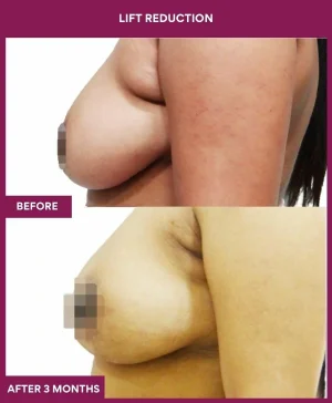 breast-reduction-with-lift-before-after-results-mumbai-india-patient05-side-left