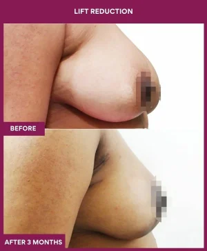 breast-reduction-with-lift-before-after-results-mumbai-india-patient05-side-right