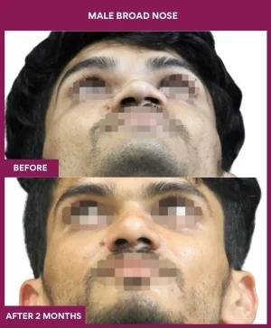 broad-nose-rhinoplasty-before-after-results-mumbai-india-patient04-front-up