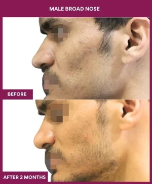 broad-nose-rhinoplasty-before-after-results-mumbai-india-patient04-side-left