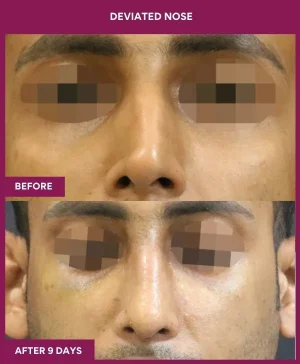 deviated-nose-correction-before-after-results-mumbai-india-patient01-front