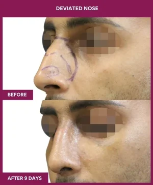 deviated-nose-correction-before-after-results-mumbai-india-patient01-left