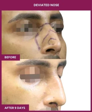 deviated-nose-correction-before-after-results-mumbai-india-patient01-right
