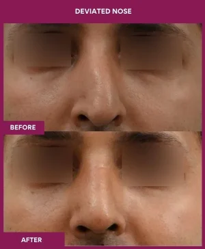 deviated-nose-correction-before-after-results-mumbai-india-patient02-front