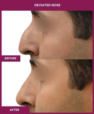 deviated-nose-correction-before-after-results-mumbai-india-patient02-left