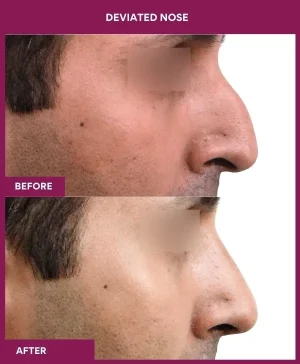 deviated-nose-correction-before-after-results-mumbai-india-patient02-right