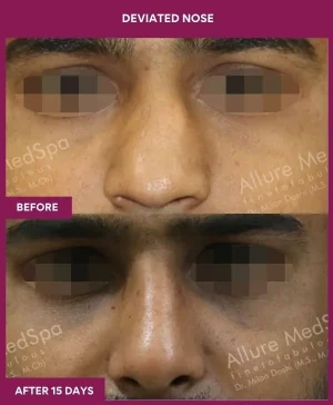 deviated-nose-correction-before-after-results-mumbai-india-patient03-front