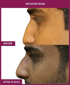 deviated-nose-correction-before-after-results-mumbai-india-patient03-left
