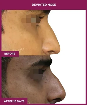 deviated-nose-correction-before-after-results-mumbai-india-patient03-right