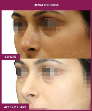 deviated-nose-correction-before-after-results-mumbai-india-patient04-left