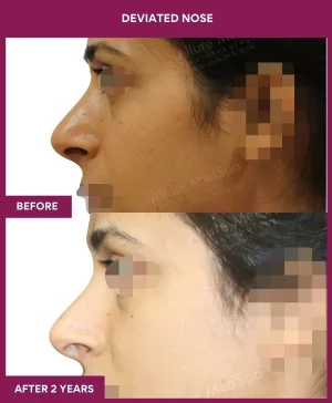 deviated-nose-correction-before-after-results-mumbai-india-patient04-left(2)