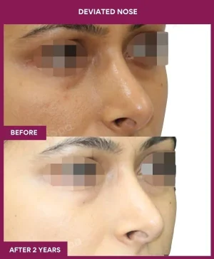 deviated-nose-correction-before-after-results-mumbai-india-patient04-right