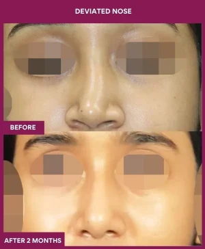 deviated-nose-correction-before-after-results-mumbai-india-patient05-front
