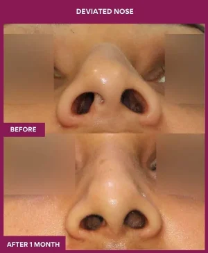 deviated-nose-correction-before-after-results-mumbai-india-patient06-front
