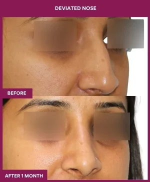 deviated-nose-correction-before-after-results-mumbai-india-patient06-right