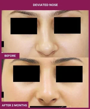 deviated-nose-correction-before-after-results-mumbai-india-patient07-front