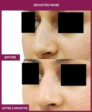 deviated-nose-correction-before-after-results-mumbai-india-patient07-left (2)