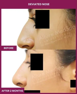 deviated-nose-correction-before-after-results-mumbai-india-patient07-left