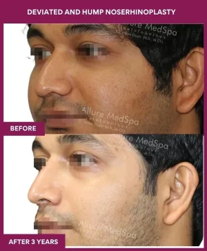 deviated-nose-correction-before-after-results-mumbai-india-patient08-front