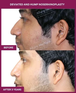 deviated-nose-correction-before-after-results-mumbai-india-patient08-left