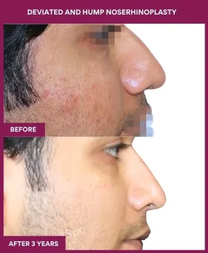 deviated-nose-correction-before-after-results-mumbai-india-patient08-right