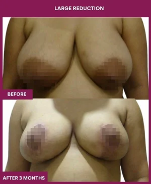 large-breast-reduction-surgery-before-after-results-mumbai-india-patient01-front