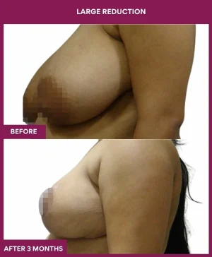 large-breast-reduction-surgery-before-after-results-mumbai-india-patient01-side-left