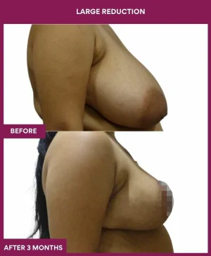 large-breast-reduction-surgery-before-after-results-mumbai-india-patient01-side-right