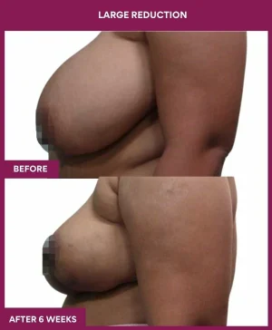 large-breast-reduction-surgery-before-after-results-mumbai-india-patient02-side-left