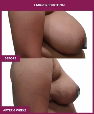 large-breast-reduction-surgery-before-after-results-mumbai-india-patient02-side-right