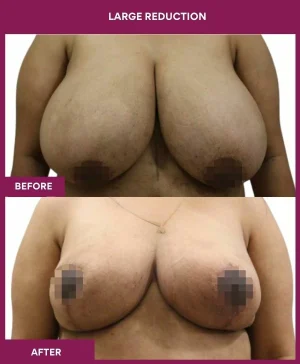 large-breast-reduction-surgery-before-after-results-mumbai-india-patient03-front