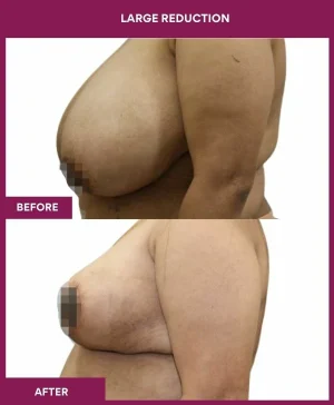 large-breast-reduction-surgery-before-after-results-mumbai-india-patient03-side-left