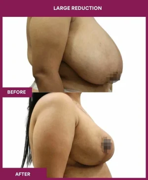 large-breast-reduction-surgery-before-after-results-mumbai-india-patient03-side-right