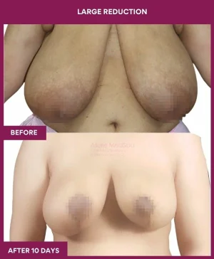 large-breast-reduction-surgery-before-after-results-mumbai-india-patient04-front