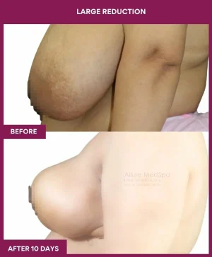 large-breast-reduction-surgery-before-after-results-mumbai-india-patient04-side-left