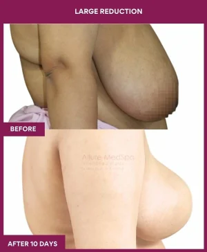 large-breast-reduction-surgery-before-after-results-mumbai-india-patient04-side-right